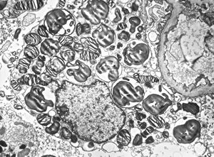 M,27y. | sea-blue histiocyte syndrome